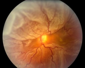 Retinal Detachment | Nader Moinfar MD | Lake Mary Orlando| Retina Specialist