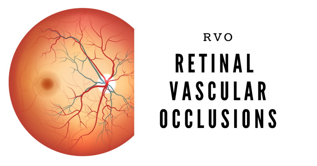 Featured Image Retinal Vascular Occlusions