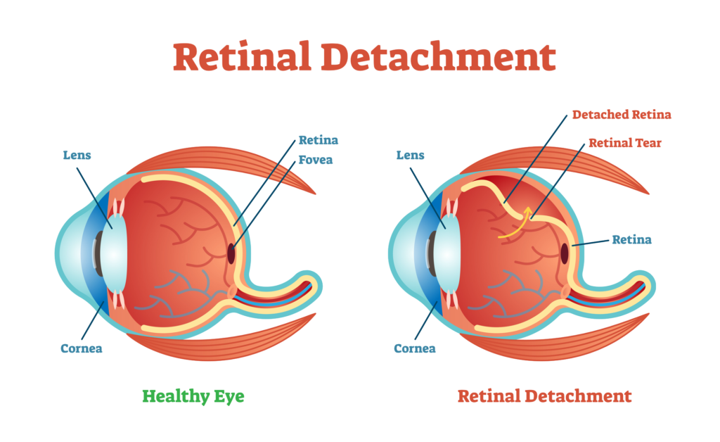 Graphic for Retinal Detachment
