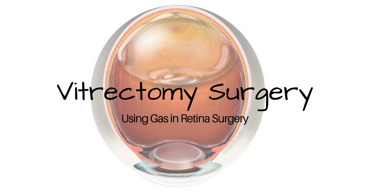 Featured Image | Using Gas in Retina Sugery | Nader Moinfar MD