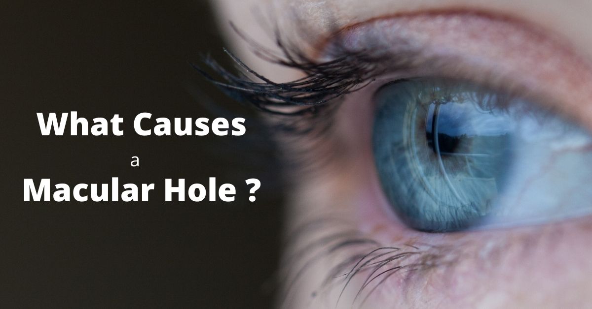 What Causes a Macular Hole?