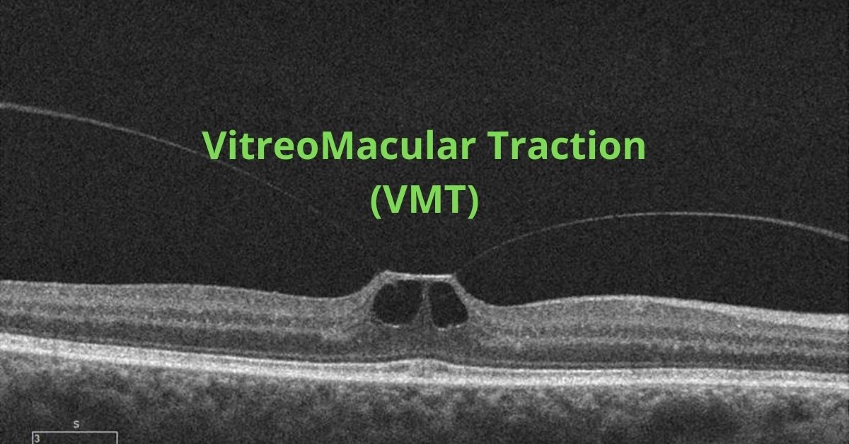 Vitreomacular Traction Syndrome