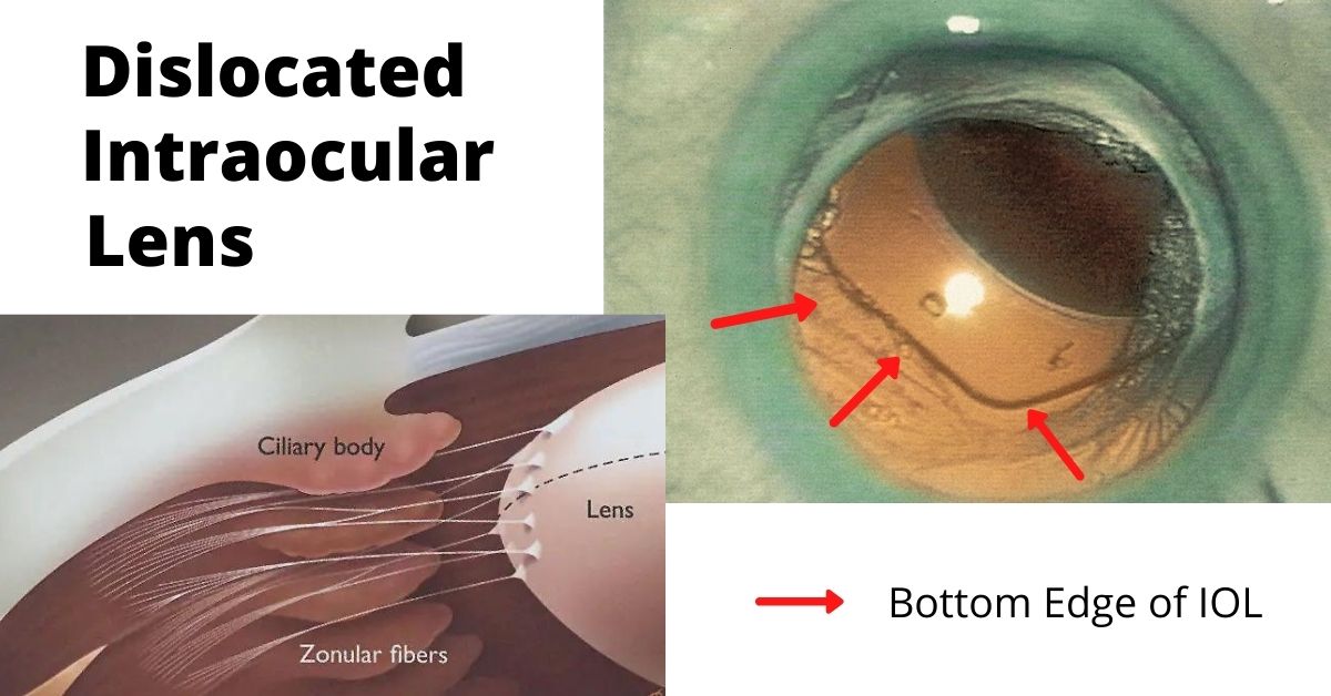 Dislocated Intraocular Lens