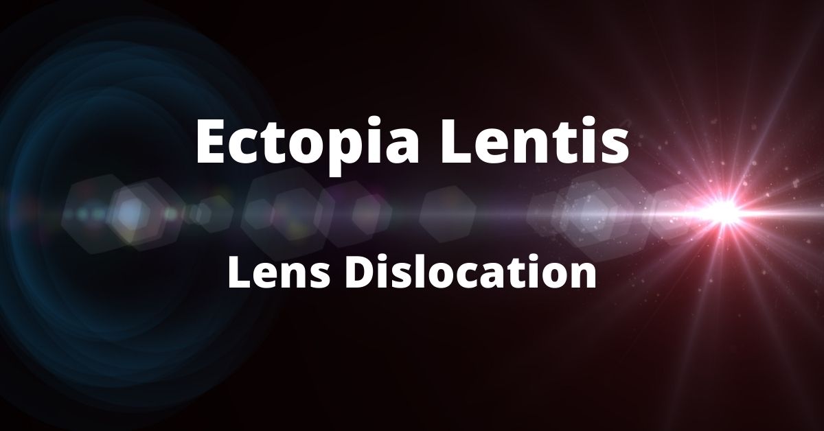 Dislocation of the Natural Lens
