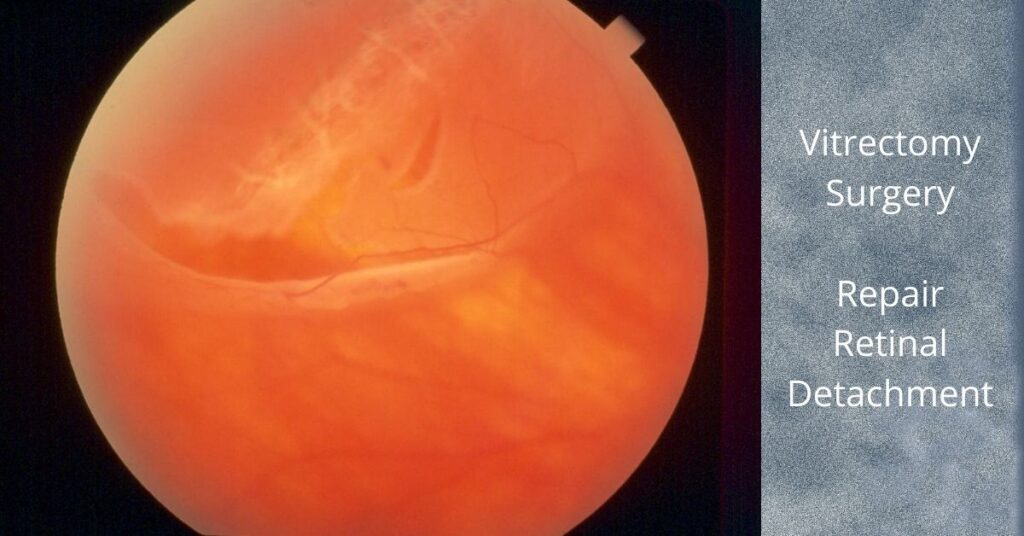 Featured Image Vitrectomy for Retinal Detachment